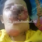 BAZNAS Kota Tangerang Galang Donasi untuk Sabrina